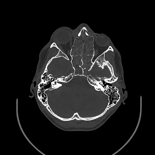 Chronic invasive fungal sinusitis (Radiopaedia 50342-55710 Axial bone window 69).jpg