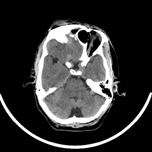 File:Chronic invasive fungal sinusitis with intraorbital and intracranial extension (Radiopaedia 56387-63046 Axial non-contrast 142).jpg