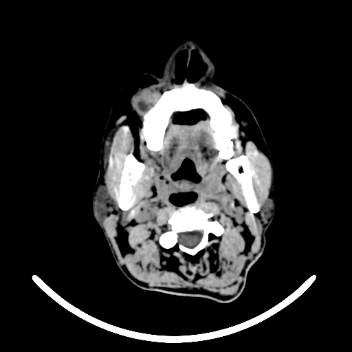 File:Chronic invasive fungal sinusitis with intraorbital and intracranial extension (Radiopaedia 56387-63046 Axial non-contrast 16).jpg