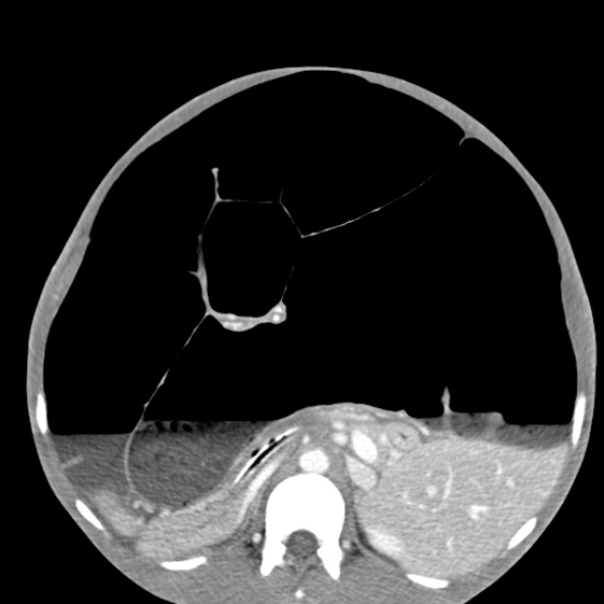 Chronic large bowel pseudo-obstruction (Radiopaedia 43181-46492 A 75).jpg