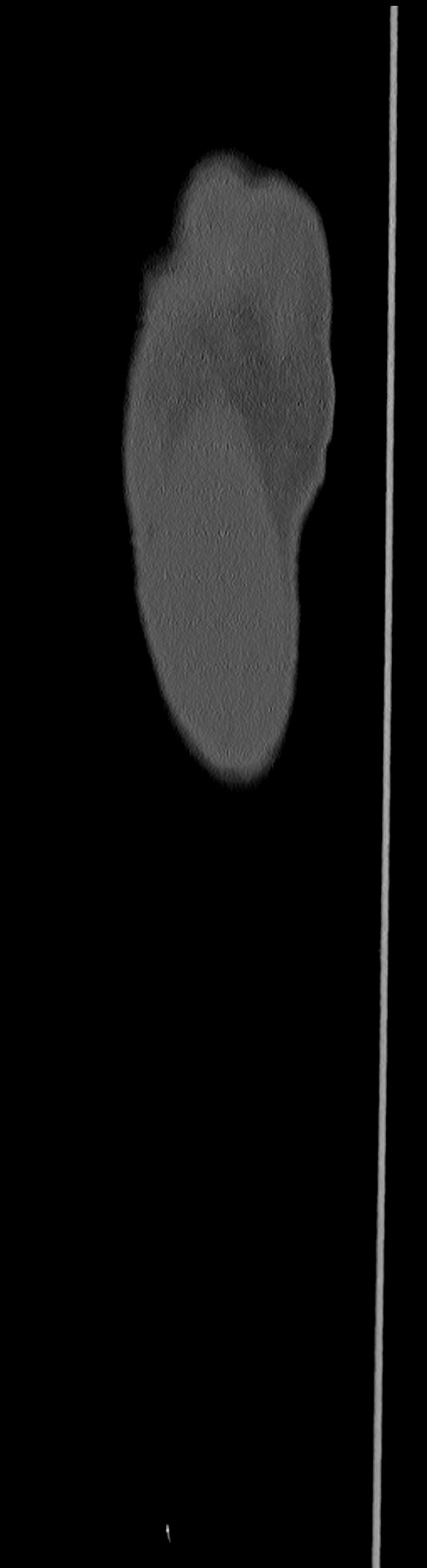 Chronic osteomyelitis (with sequestrum) (Radiopaedia 74813-85822 C 7).jpg