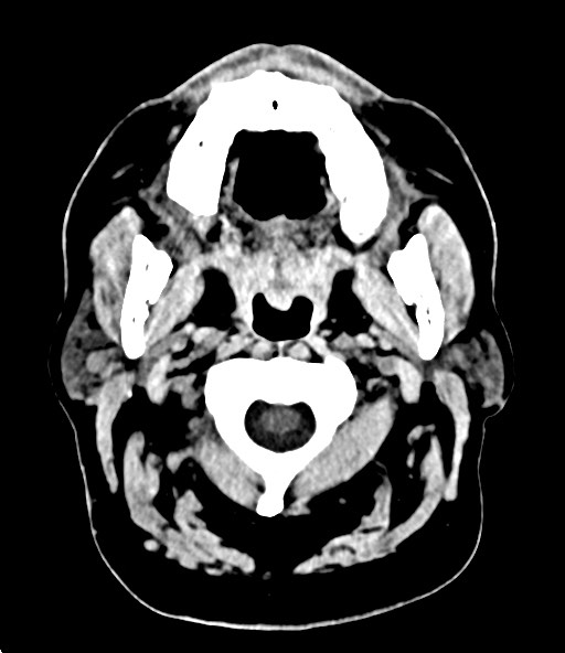 File:Chronic osteomyelitis - calvarial (severe) (Radiopaedia 69668-79616 Axial non-contrast 17).jpg