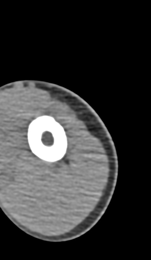 Chronic osteomyelitis of the distal humerus (Radiopaedia 78351-90971 Axial non-contrast 23).jpg