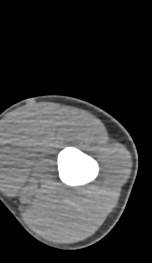 Chronic osteomyelitis of the distal humerus (Radiopaedia 78351-90971 Axial non-contrast 48).jpg