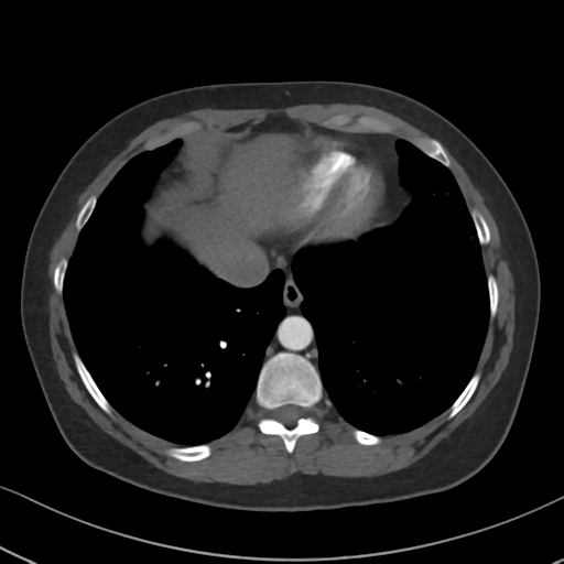 Chronic pulmonary embolus (Radiopaedia 39129-41341 Axial C+ CTPA 79).png