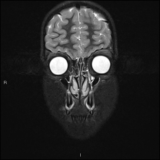 File:Chronic reactive multifocal osteomyelitis (CRMO) - mandible (Radiopaedia 56405-63069 Coronal STIR 7).jpg