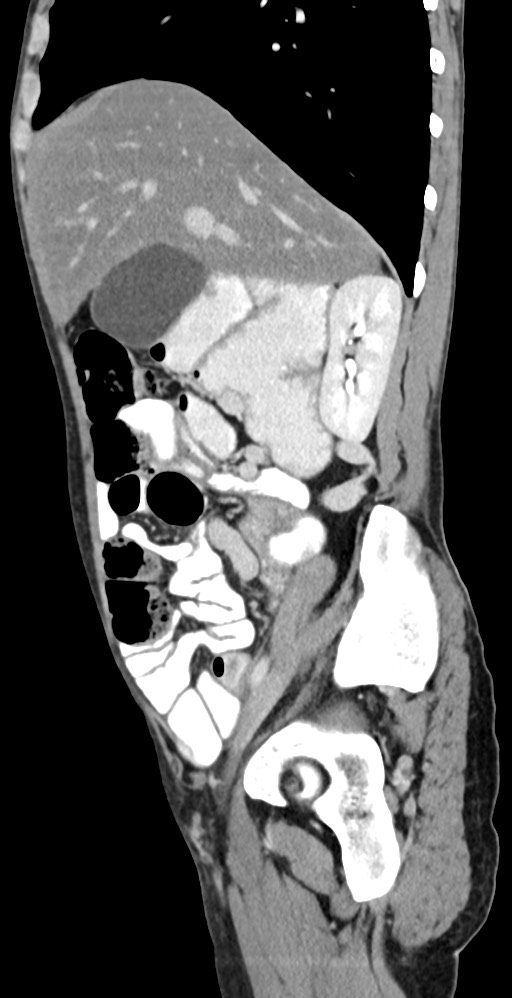 Chronic small bowel volvulus (Radiopaedia 75224-86322 C 100).jpg