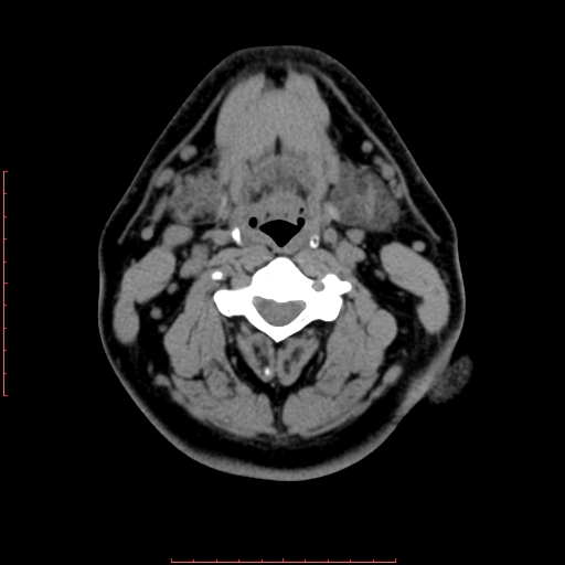 File:Chronic submandibular sialolithiasis (Radiopaedia 69817-79814 Axial non-contrast 126).jpg