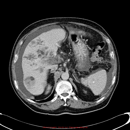 File:Cirrhosis and hepatocellular carcinoma in the setting of hemochromatosis (Radiopaedia 75394-86595 B 29).jpg