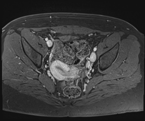 File:Class II Mullerian duct anomaly- unicornuate uterus with rudimentary horn and non-communicating cavity (Radiopaedia 39441-41755 Axial T1 fat sat 62).jpg