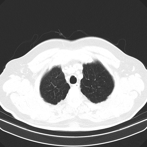 File:Classic complicated silicosis (Radiopaedia 49720-54961 Axial lung window 7).jpg
