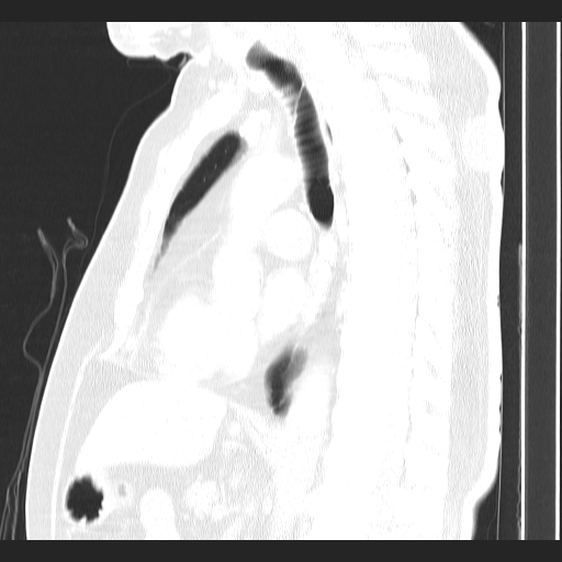 Classic complicated silicosis (Radiopaedia 49720-54961 Sagittal lung window 31).jpg