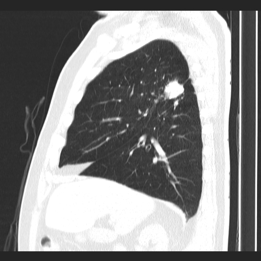 Classic complicated silicosis (Radiopaedia 49720-54961 Sagittal lung window 44).jpg
