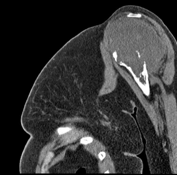Clear cell chondrosarcoma - humerus (Radiopaedia 63104-71612 D 23).jpg