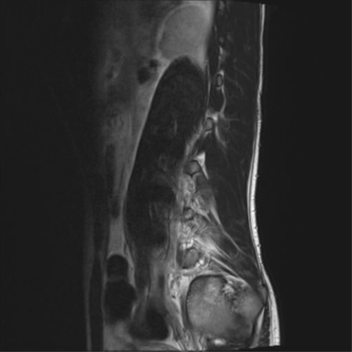 File:Clear cell meningoma - lumbar spine (Radiopaedia 60116-67690 Sagittal T2 2).png