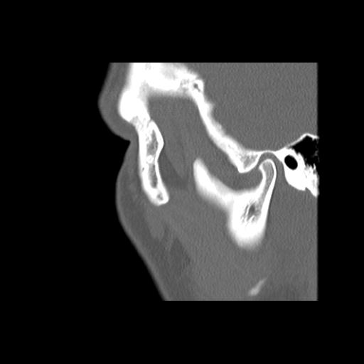 Cleft hard palate and alveolus (Radiopaedia 63180-71710 Sagittal bone window 10).jpg