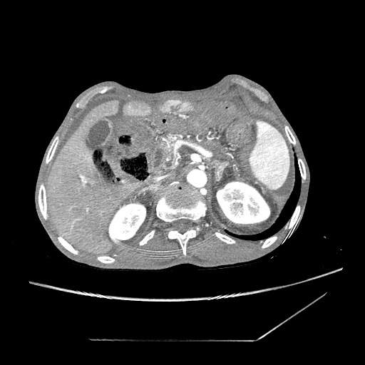 Closed-loop obstruction due to peritoneal seeding mimicking internal hernia after total gastrectomy (Radiopaedia 81897-95864 A 31).jpg