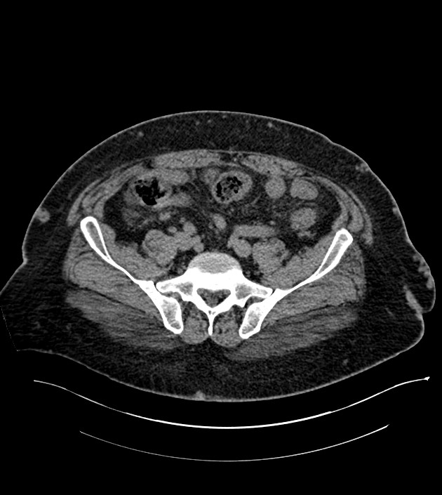 Closed-loop small bowel obstruction-internal hernia (Radiopaedia 78439-91096 Axial non-contrast 116).jpg