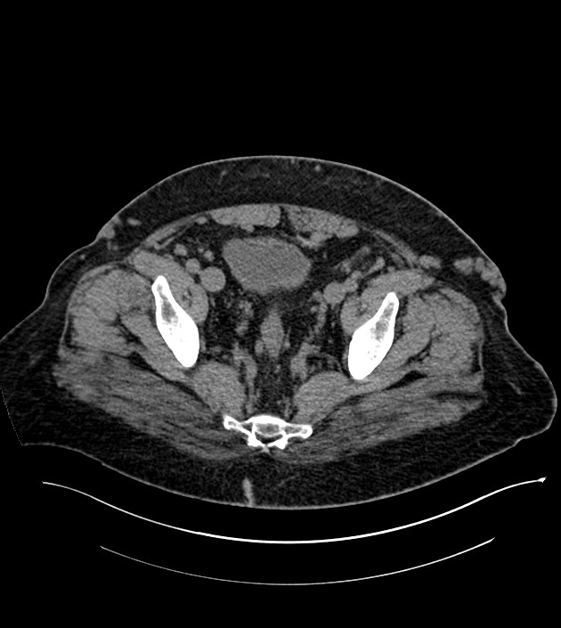 Closed-loop small bowel obstruction-internal hernia (Radiopaedia 78439-91096 Axial non-contrast 134).jpg