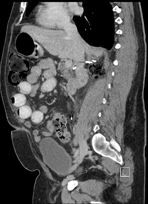 Closed loop obstruction - internal hernia into nephrectomy bed (Radiopaedia 59867-67320 C 57).jpg