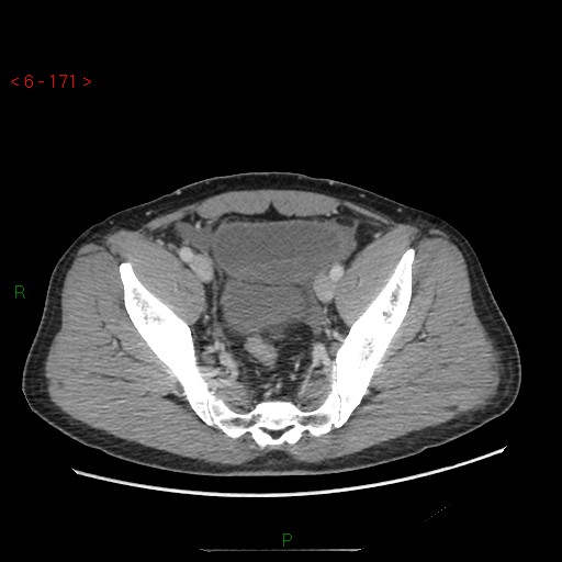 File:Closed loop obstruction and appendicular stump mucocele (Radiopaedia 54014-60163 A 102).jpg