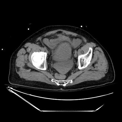 File:Closed loop obstruction due to adhesive band, resulting in small bowel ischemia and resection (Radiopaedia 83835-99023 Axial non-contrast 136).jpg