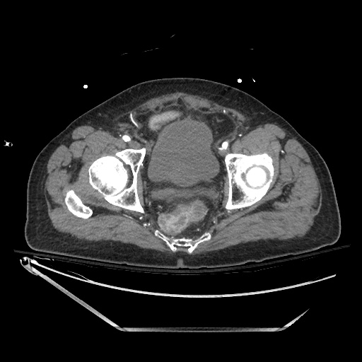 Closed loop obstruction due to adhesive band, resulting in small bowel ischemia and resection (Radiopaedia 83835-99023 B 141).jpg