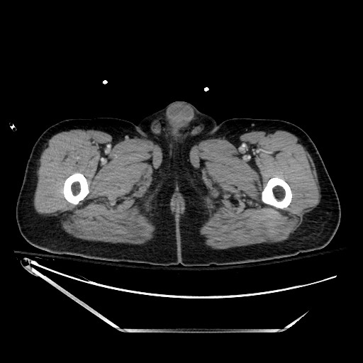 File:Closed loop obstruction due to adhesive band, resulting in small bowel ischemia and resection (Radiopaedia 83835-99023 D 180).jpg