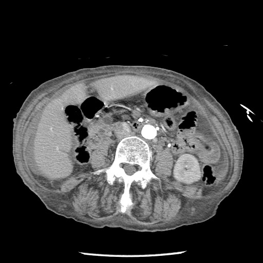 File:Closed loop small bowel obstruction - adhesions and infarct (Radiopaedia 85125-100678 A 87).jpg