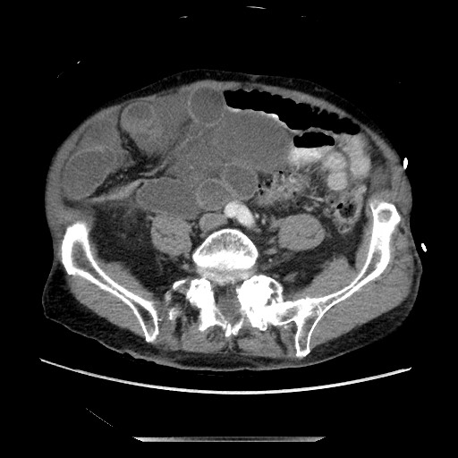 Closed loop small bowel obstruction - adhesive disease and hemorrhagic ischemia (Radiopaedia 86831-102990 A 126).jpg