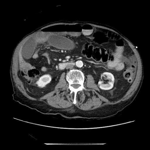 Closed loop small bowel obstruction - adhesive disease and hemorrhagic ischemia (Radiopaedia 86831-102990 A 95).jpg