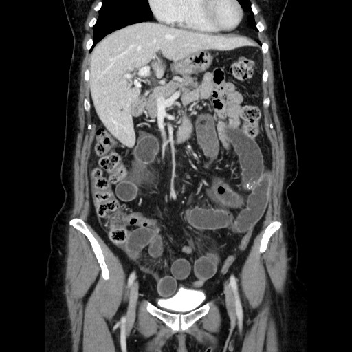 Closed loop small bowel obstruction due to adhesive bands - early and late images (Radiopaedia 83830-99015 B 49).jpg