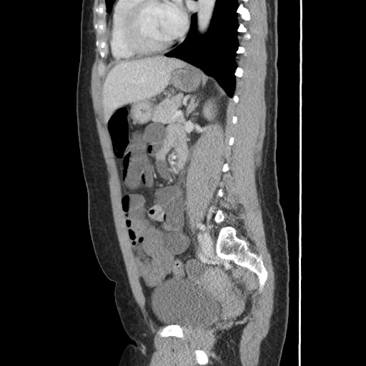 Closed loop small bowel obstruction due to trans-omental herniation (Radiopaedia 35593-37109 C 40).jpg
