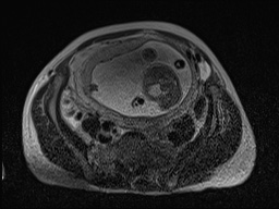 Closed loop small bowel obstruction in pregnancy (MRI) (Radiopaedia 87637-104031 D 18).jpg