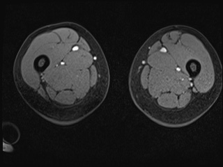 Closed loop small bowel obstruction in pregnancy (MRI) (Radiopaedia 87637-104031 G 67).jpg