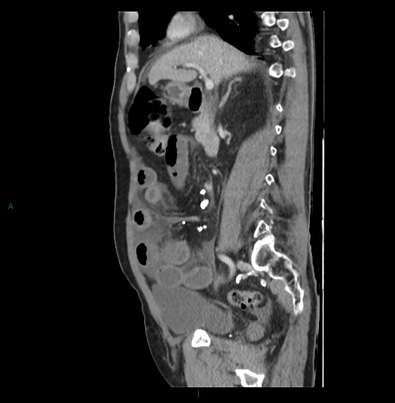 File:Closed loop small bowel obstruction with ischemia (Radiopaedia 84180-99456 C 38).jpg