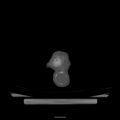 Cloverleaf skull (Radiopaedia 91901-109710 Axial bone window 143).jpg