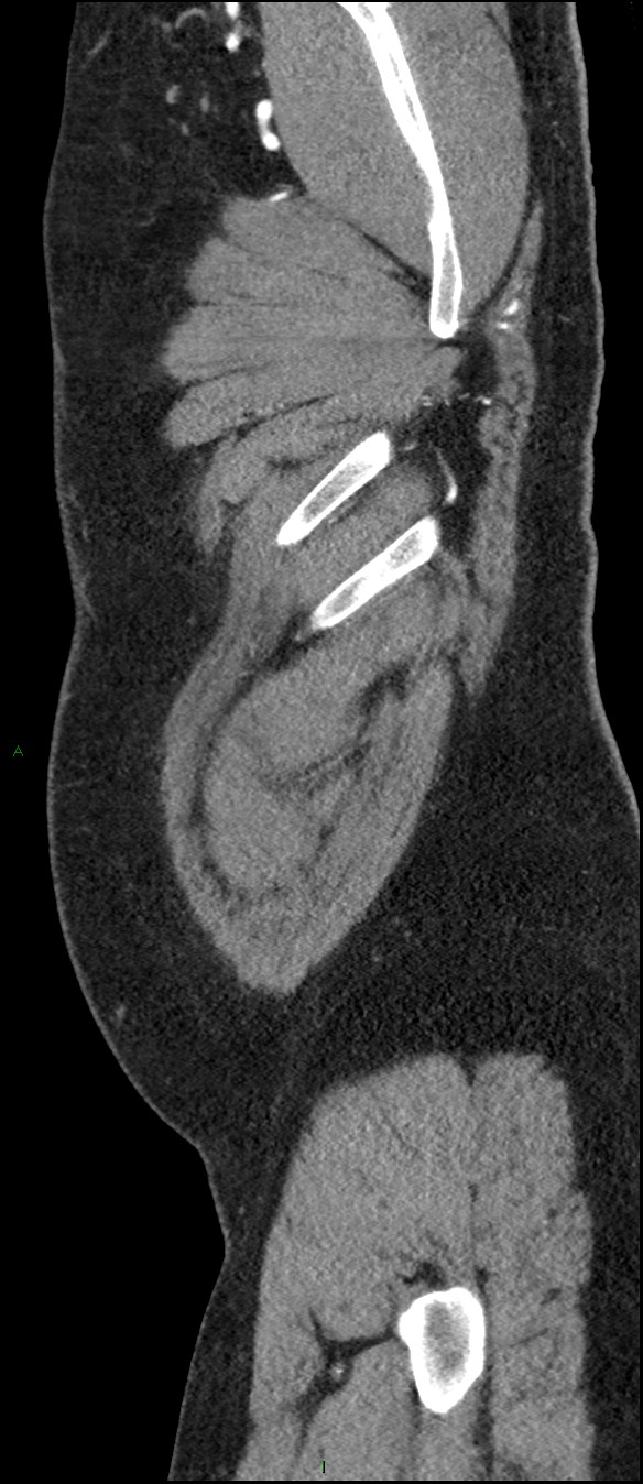 Coarctation of the aorta (Radiopaedia 74632-88521 C 8).jpg