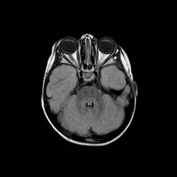 File:Cochlear nerve aplasia - unilateral (Radiopaedia 87910-104413 Axial FLAIR 10).jpg