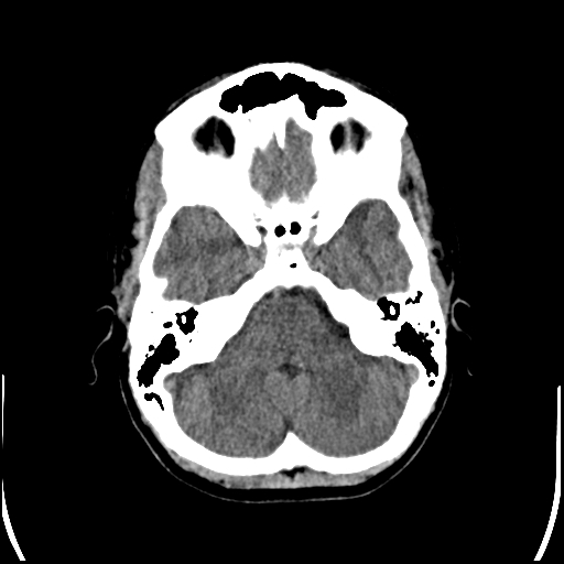 Colloid cyst (Radiopaedia 78104-90633 Axial non-contrast 26).jpg
