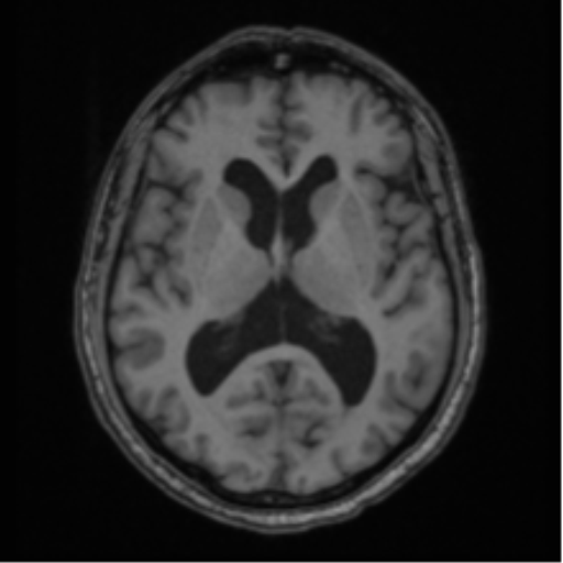 File:Colloid cyst of the third ventricle (Radiopaedia 86571-102662 Axial T1 41).png