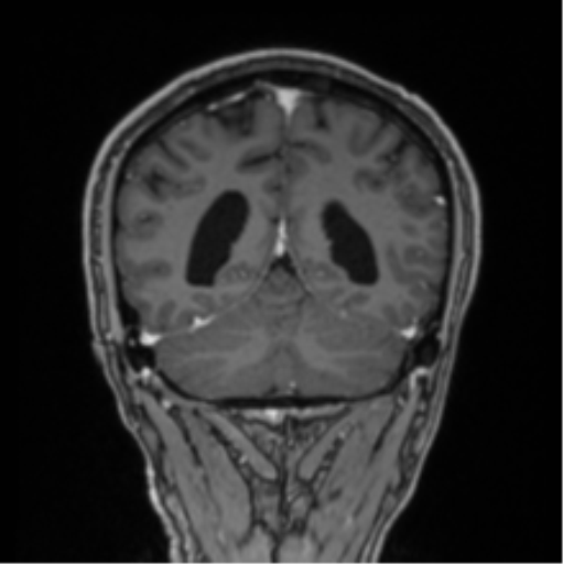 File:Colloid cyst of the third ventricle (Radiopaedia 86571-102662 Coronal T1 C+ 27).png