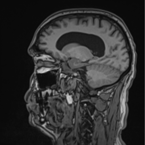 File:Colloid cyst of the third ventricle (Radiopaedia 86571-102662 Sagittal T1 30).png