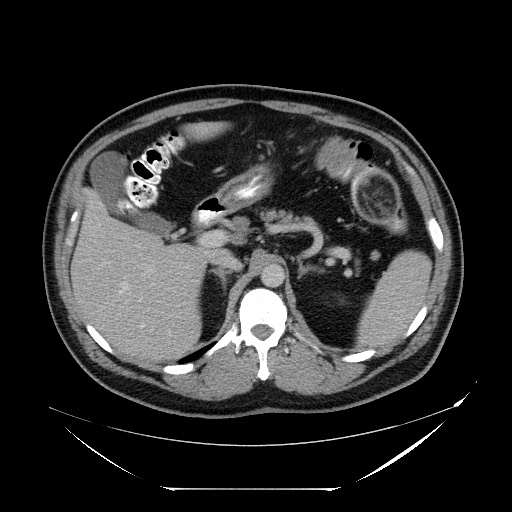 Colocolic intussusception due to lipoma (Radiopaedia 73712-84508 A 33).jpg
