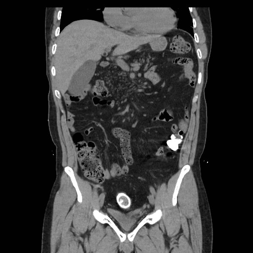 File:Colocutaneous fistula in Crohn's disease (Radiopaedia 29586-30093 E 32).jpg