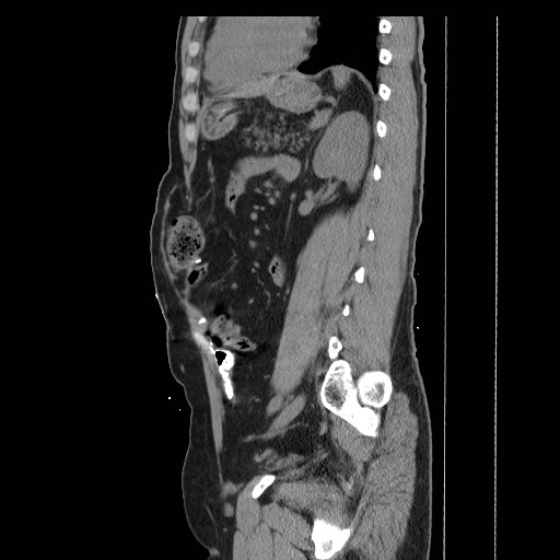 Colocutaneous fistula in Crohn's disease (Radiopaedia 29586-30093 F 29).jpg