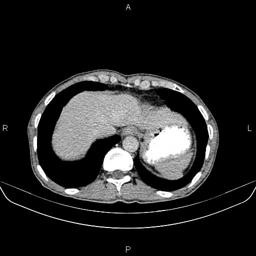 File:Colon adenocarcinoma - hepatic flexure (Radiopaedia 85635-101395 Axial C+ delayed 11).jpg