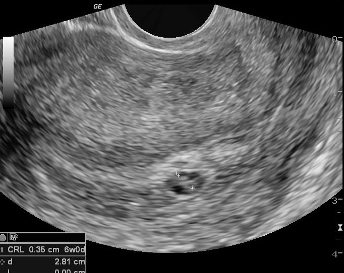 File:First trimester oligohydramnios (Radiopaedia 9791).jpg