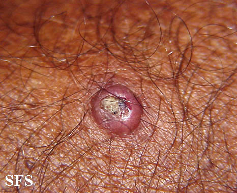 File:Keratoacanthoma (Dermatology Atlas 11).jpg