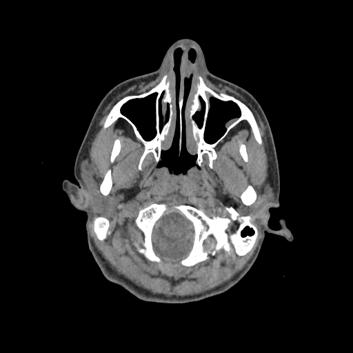 File:Nasal pyogenic granuloma (lobular capillary hemangioma) (Radiopaedia 85536-101244 Axial non-contrast 34).jpg